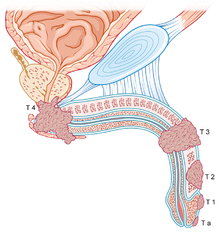 PENILE CANCER