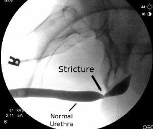 STRICTURE URETHRA