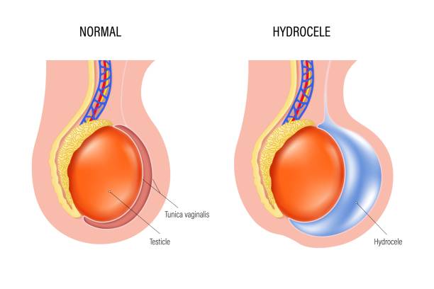 HYDROCELE