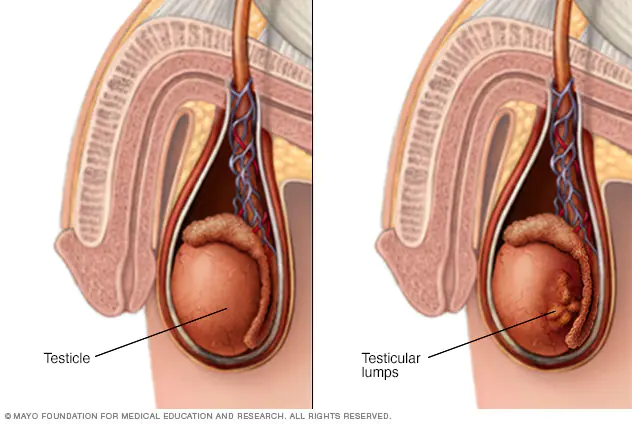 TESTICULAR CANCER