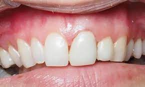 Enhance Your Look with Teeth Crowns in Dubai