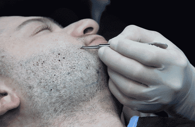 Enhance Your Style with Beard Hair Transplant in Dubai