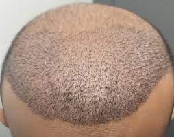 Get the Best Hair Replacement in Dubai Today