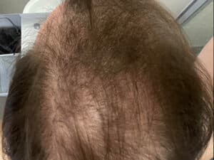 Hair Replacement: Transform Your Look