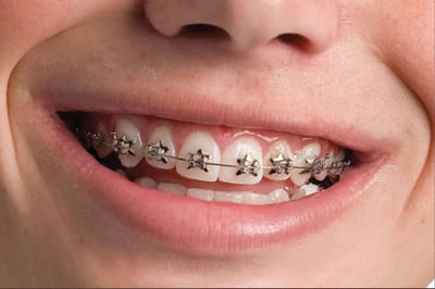 Dental Braces Your Smile Transformation Awaits