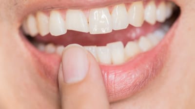 Unlock a Brighter Smile with Teeth Whitening