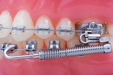 Dental Braces: Straighten Your Teeth Effectively