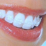 Get a Confident Smile with Dental Braces Health