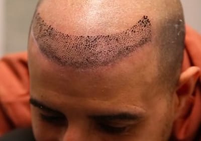 Scalp Micropigmentation Quick and Effective Hairline Fix