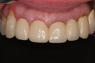 Smile Confidently with Our Dental Implant Practice