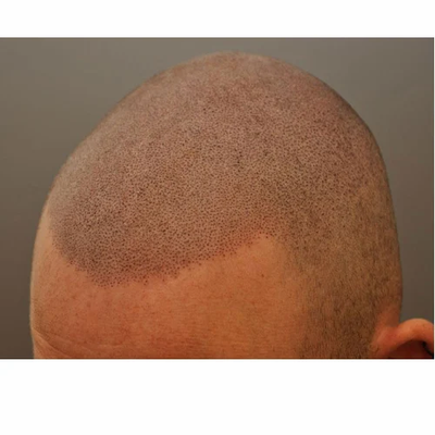 Boost Your Look with Scalp Micropigmentation
