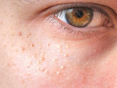 Fast-Acting Milia Treatments That Work