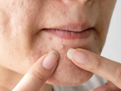 Milia Treatments Say Goodbye to White Bumps