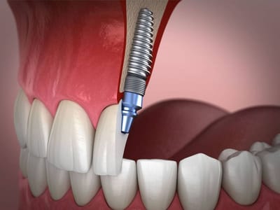 Dental Implants Transforming Smiles with Advanced Tech
