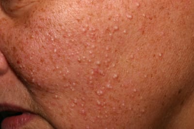 Say Goodbye to Milia with These Treatments