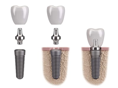 From Consultation to Completion Dental Implants