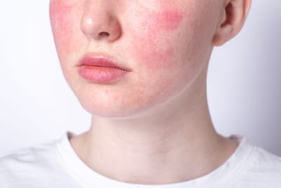 Clear Redness with Top Rosacea Treatment
