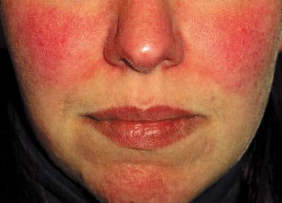 Gentle Rosacea Treatment for Calmer Skin