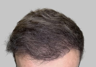 Maximize Your Hair Transplant Results at Low Cost