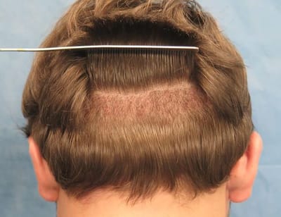 Hair Transplant Cost Affordable Options for You