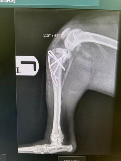 Tibial crest avulsion fracture
