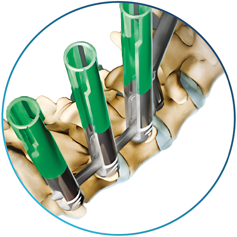 SISTEMA MÍNIMAMENTE INVASIVO