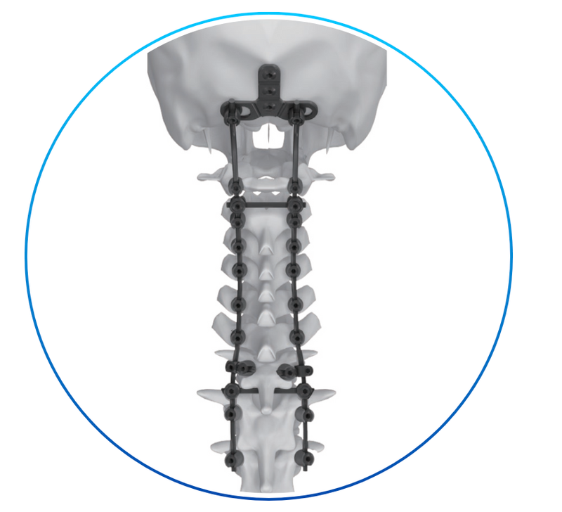 SISTEMA DE CORPECTOMIA