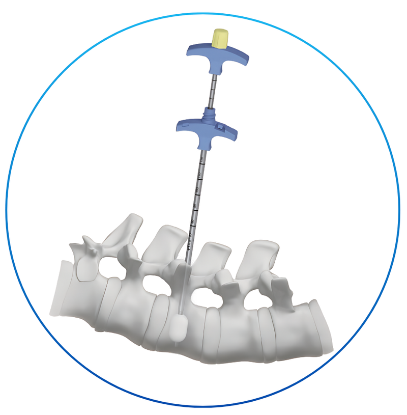 CIFOPLASTÍA Y VERTEBROPLASTÍA