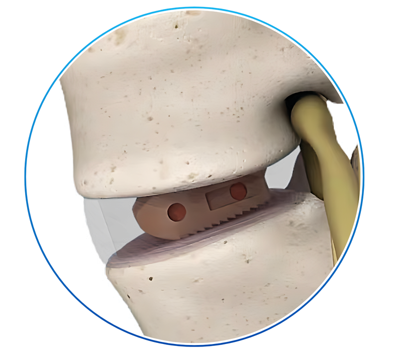 CAJA DE FUSIÓN INTERSOMÁTICA PLIF