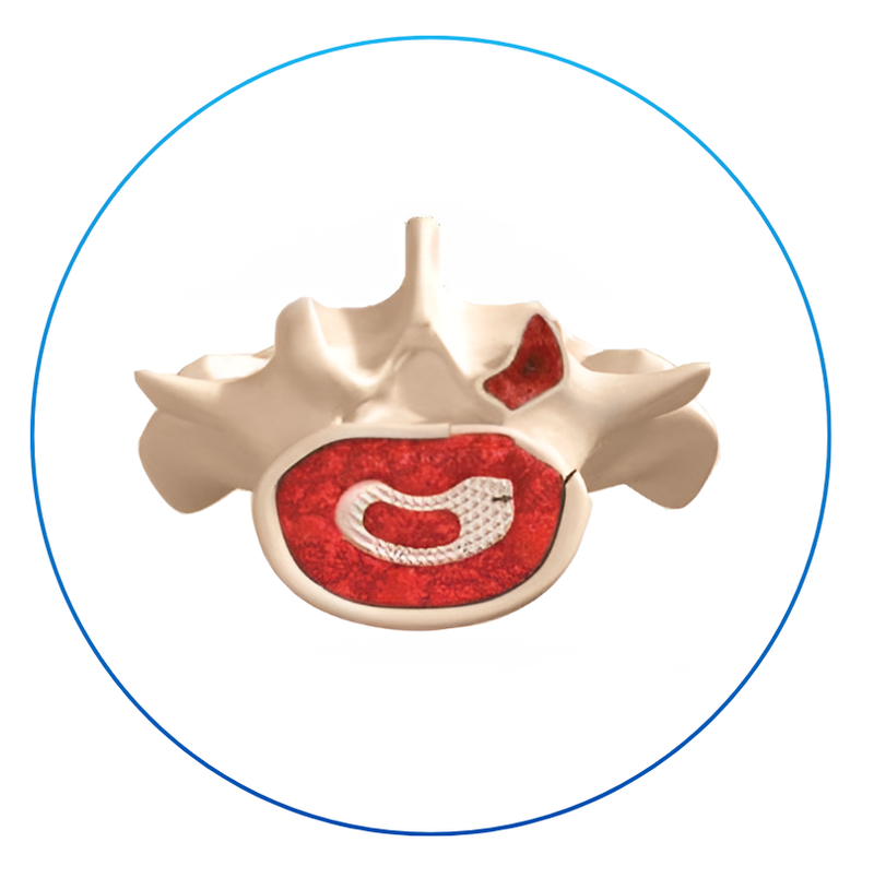 CAJA DE FUSIÓN INTERSOMÁTICA LUMBAR TLIF