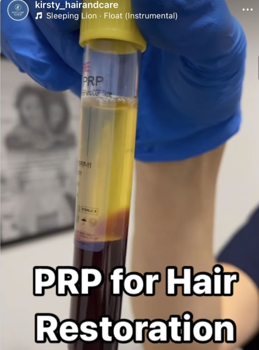 Benefits of PRP after Hair Transplantation