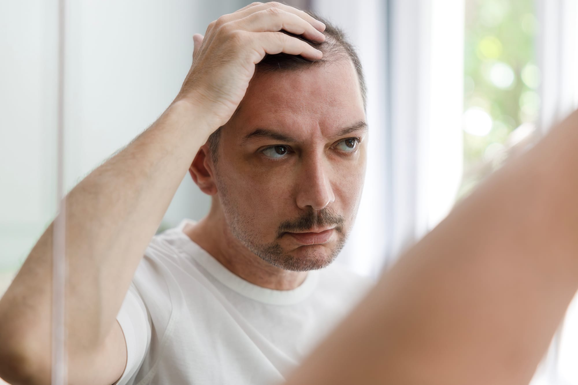 Male Pattern Hair Loss