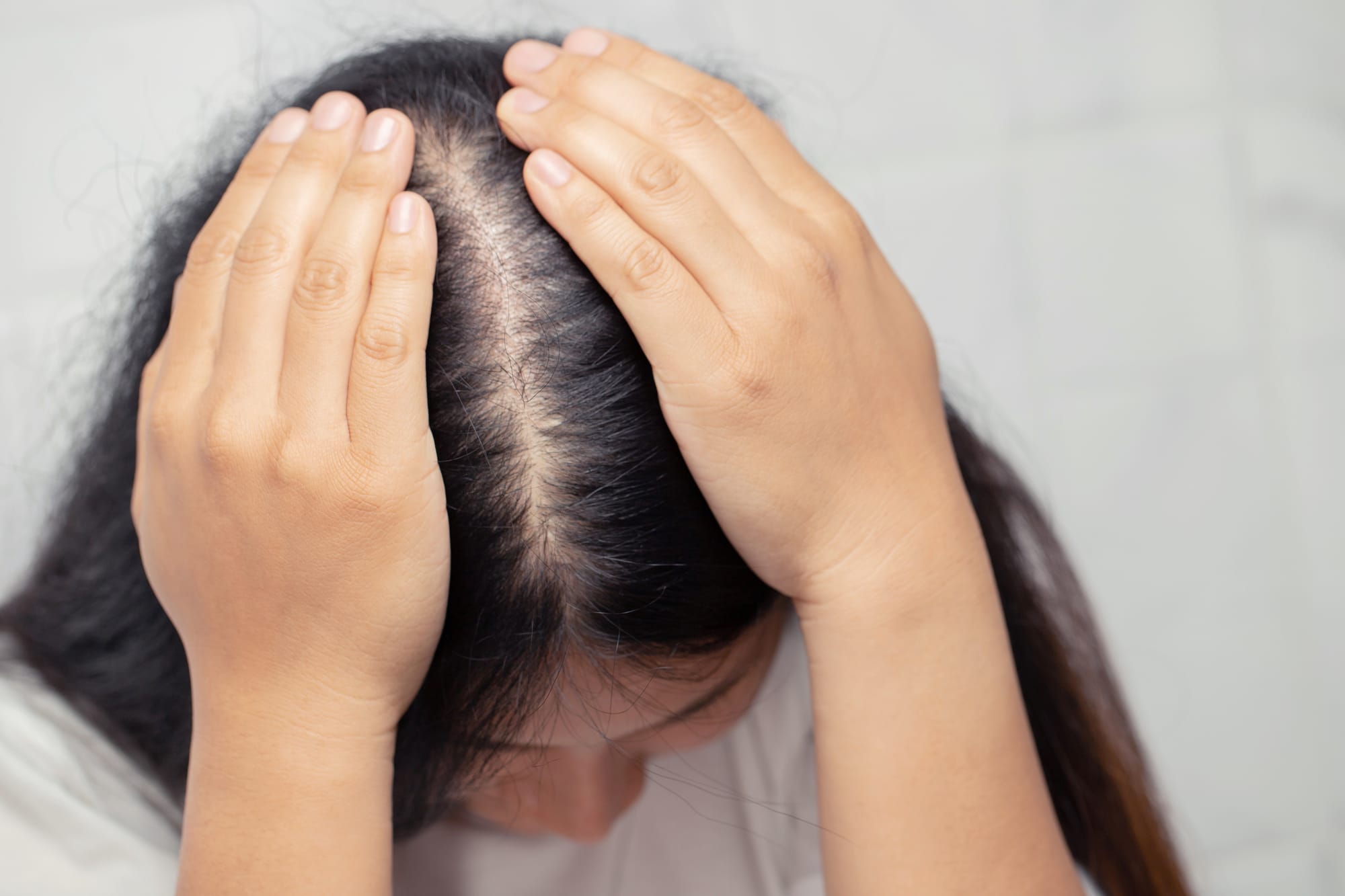 Female Pattern Hair Loss