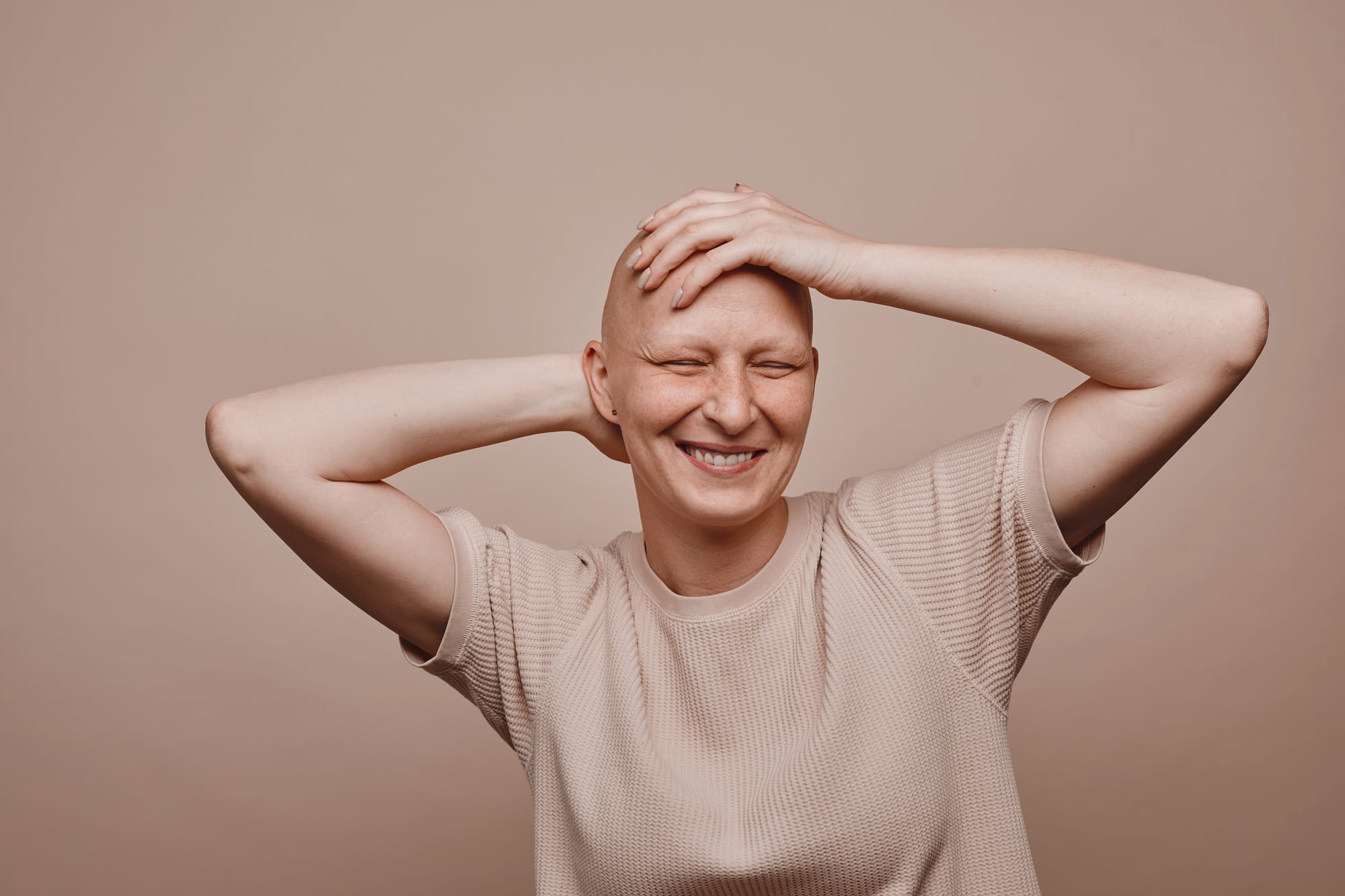 What is Alopecia?