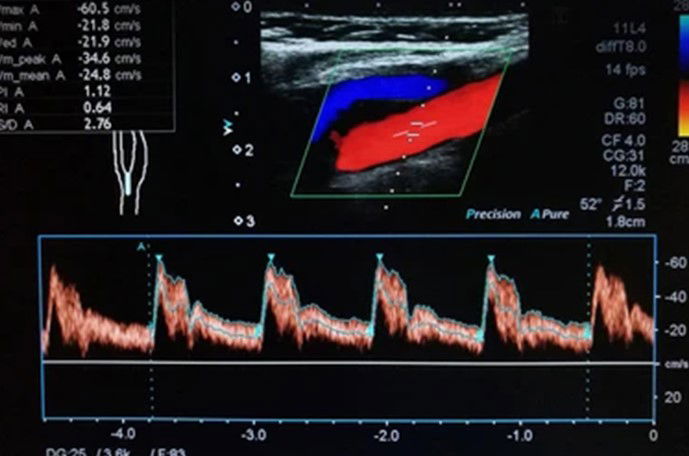 Colour Doppler Ultrasound