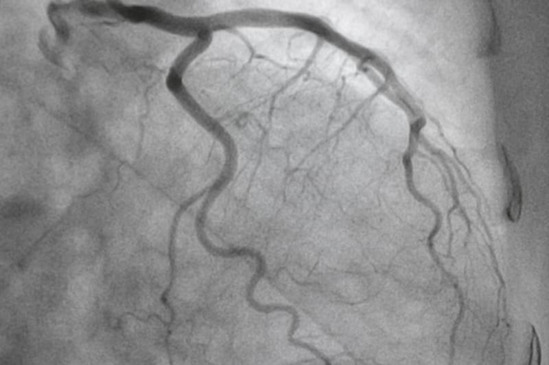 Interventional Cardiology