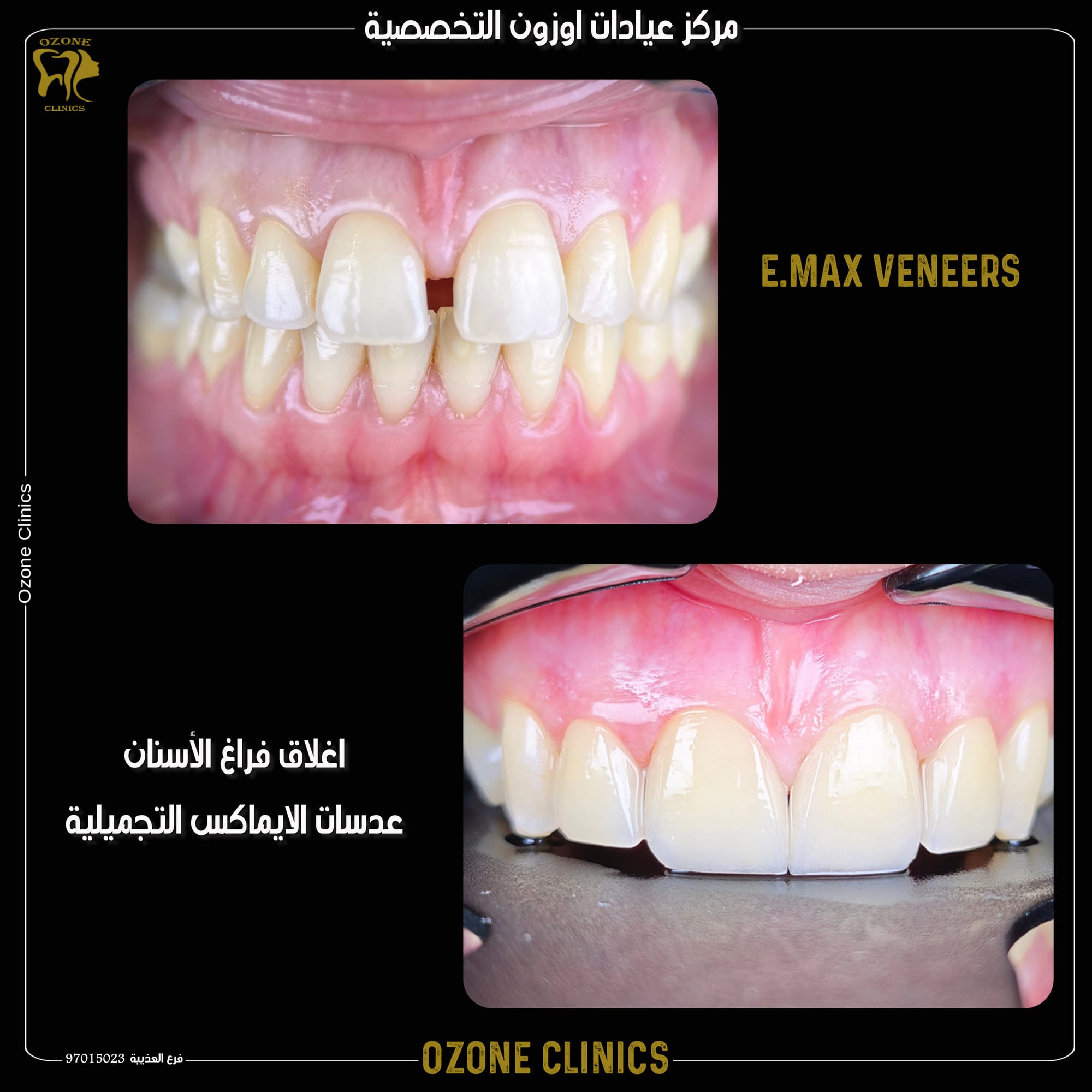 close spaces between teeth