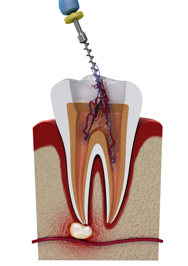 Root Canal treatment