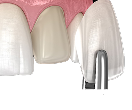Veneers