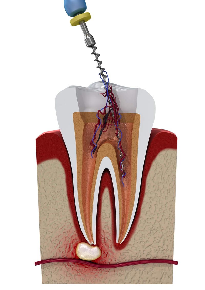 Root Canal treatment