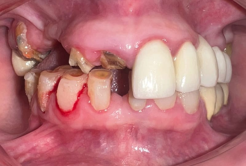 Complex implants operation