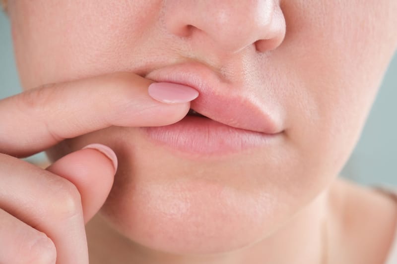 Lip Fillers