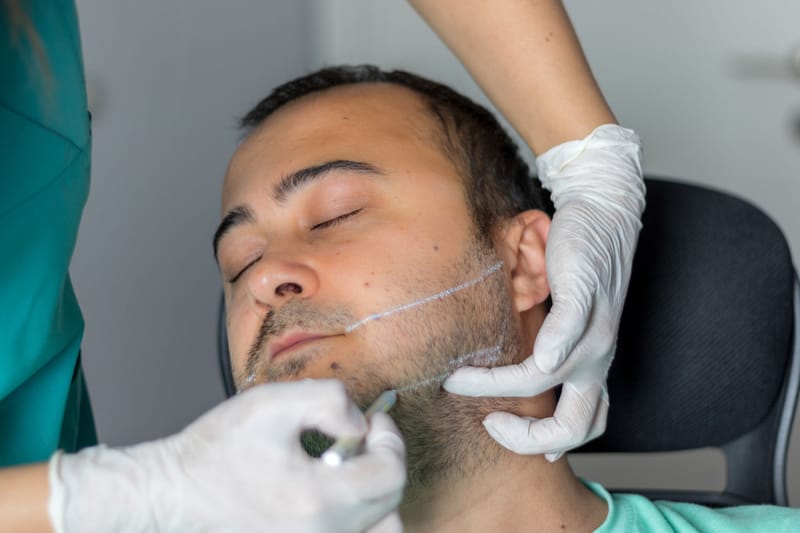 زراعة الشارب و اللحية