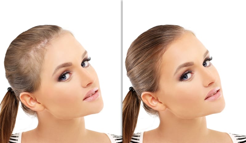 زراعة الشعر للنساء