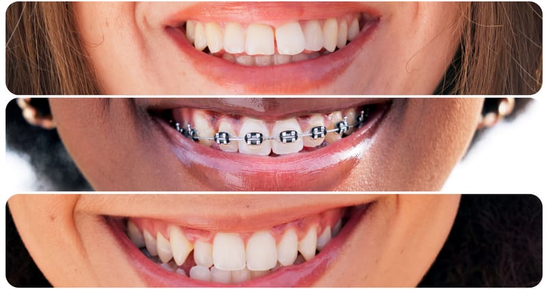 Types of dental braces