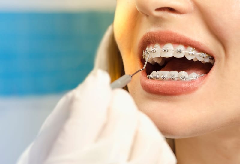 Steps of Dental Orthodontics & Braces