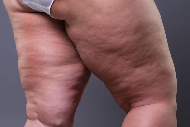 Cellulite reduction