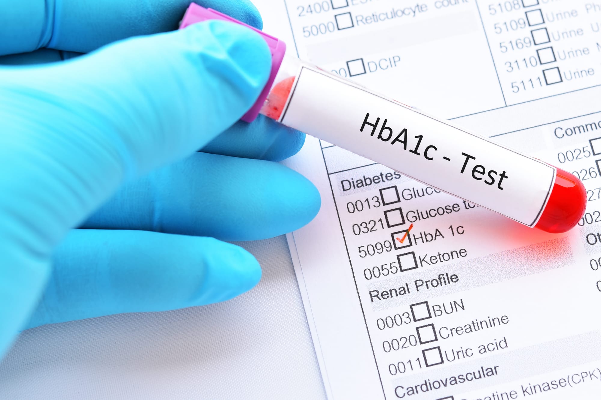 HbA1c - hemoglobina glicozilată - testul de elecție pentru diagnosticarea și monitorizarea diabetului zaharat