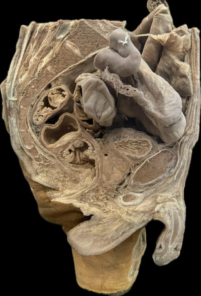 Corte Sagital de Pelvis Izquierdo