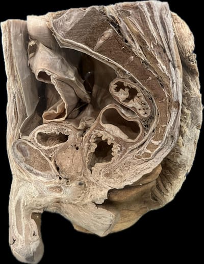 Corte Sagital de Pelvis Derecho